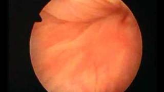 hysteroscopic aspect of adenomyosis [upl. by Nevla578]