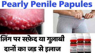 Pearly Penile Papules  लिंग पे सफ़ेद दानो का लेज़र से इलाज  homeopathic medicine for genital warts [upl. by Eynahpets488]