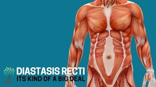 Heres Why Diastasis Recti is a Big Deal  Diastasis Ed 1 [upl. by Hylton240]