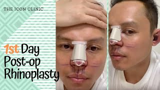 Rhinoplasty In the Philippines 1st Day Post Opp [upl. by Earased379]