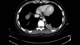 What is your diagnosis Myocardial infarct on Chest CT [upl. by Neelyt]