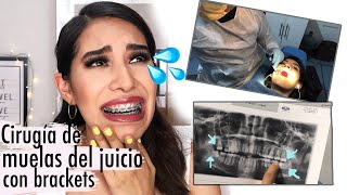 Mi experiencia con brackets 6  CIRUGÍA DE MUELAS DEL JUICIO Cirugía de Cordales Carel Quezada [upl. by Eldwon438]