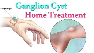 Ganglion Cyst Home Treatment  How to Get Rid of Ganglion Cysts Naturally At Home [upl. by Irved]