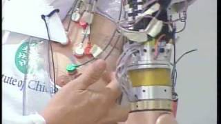 Brain Controls Artificial Arm [upl. by Burrus]