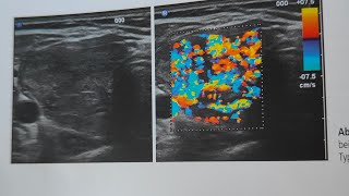 Facharztprüfung Innere Medizin Morbus Basedow [upl. by Odla]