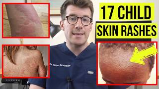 Identifying SKIN RASHES in BABIES and CHILDREN  DOCTOR explains 17 COMMON SKIN CONDITIONS [upl. by Torto275]