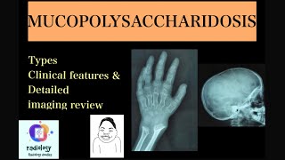 MUCOPOLYSACCHARIDOSIS Case discussion of types clinicoradiological features Morquios amp Hurlers [upl. by Narot]