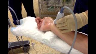 US GUIDED RADIAL ARTERY CANNULATION [upl. by Donetta]