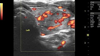 Focal acute viral thyroiditis left lobe with multinodular goiter ultrasound color Doppler video [upl. by Gildus]