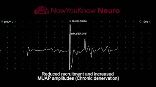 EMG Chronic denervation [upl. by Philippa]