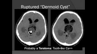 Pineal Region Tumors RadiologicPathologic Correlation [upl. by Anirtal]