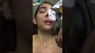 Removing a Nasal Stent 5 Days after Rhinoplasty [upl. by Crowley420]