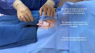 Femoral artery access [upl. by Formica]