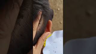 Itchy Scalp Satisfying And Picking Lice [upl. by Anma603]