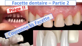 Facette dentaire  Facette Vs Couronnes Piège à éviter  Guide complet  partie 2 [upl. by Dall]