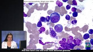 Two Diagnoses in One Bone Marrow with Megan Nakashima MD [upl. by Elisabeth432]