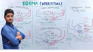 Interstitial Edema Pathology  Edema part 3 [upl. by Ycnay]