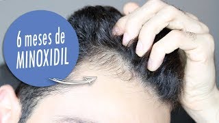 MINOXIDIL DEPOIS 6 MESES [upl. by Namyl]