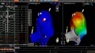 RVOT VT mapping EPstudy ablation [upl. by Vonnie766]