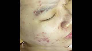 old age acne blackhead elder new 2024  sac be spa acne full details explain [upl. by Rehportsirhc]