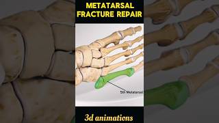 Metatarsal Fracture Repair Process shorts viral metatarsal fracture [upl. by Reniti]