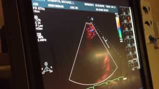 My Hear ECHO  Echocardiogram [upl. by Auoy]