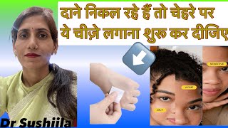 Acne को कैसे ट्रीट करें क्यों होता है Acne Best Acne Treatment [upl. by Riancho]