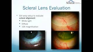 Scleral Lenses Basic to Advanced Troubleshooting [upl. by Gustavus197]