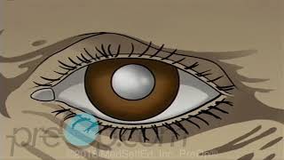 Cataract  Small Incision Surgery PreOp® Patient Education and Engagement [upl. by Colner]