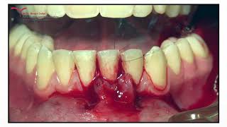 Coronally Advanced Flap after Connective Tissue Graft  Part 2 [upl. by Rosenzweig789]