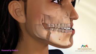 Surgical Orthodontic Treatment for Underbite or Crossbite  BSSO Mandibular Setback [upl. by Sert899]