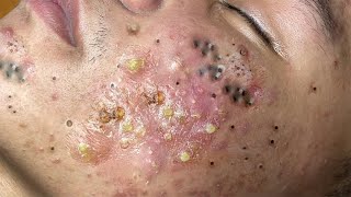 Big Cystic Acne Blackheads Extraction Blackheads amp Milia Whiteheads Removal Pimple Popping  6761 [upl. by Euqinorev]