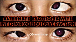 SquintStrabismus Examination  Alternate Esotropia With Inferior Oblique Overaction [upl. by Eibbed]