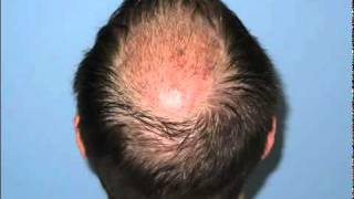 HAIR TRANSPLANT OF THE CROWN WITH DR PAUL SHAPIRO [upl. by Notrom]