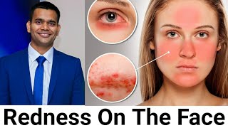 Redness On The Face  Rosacea My Opinion And Natural Treatment [upl. by Acul]