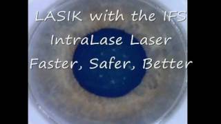 IntraLase LASIK with the iFS [upl. by Lilith]