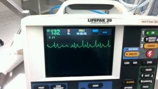 Chemical cardioversion of tachycardia to dx Flutter [upl. by Herrington]