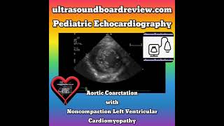 Noncompaction Left Ventricular Cardiomyopathy [upl. by Sylram649]