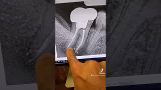 Root canal retreatment of tooth 31 through a crown in one visit [upl. by Berwick]