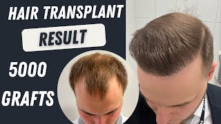 Hair Transplant Before and After 5000 Grafts Result 12 months  Hair Transplant Timelapse [upl. by Hagi596]