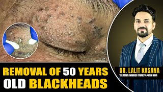 REMOVAL OF 50 YEARS OLD BLACKHEADS II Dr Lalit Kasanas [upl. by Skeie50]