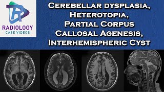 Cerebellar dysplasia Heterotopia Partial Corpus Callosal Agenesis Interhemispheric Cyst [upl. by Darrell11]