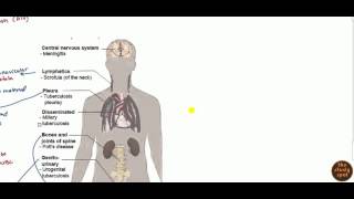 Lymph Node Tuberculosis Symptoms Diagnosis amp Treatment I Dr Ankit Parakh TB Specialist [upl. by Orabla452]