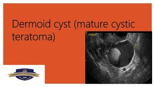 dermoid cyst [upl. by Thorman]