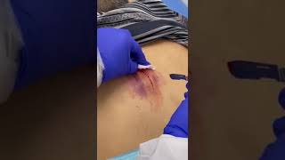 Back Sebaceous Cyst Removal [upl. by Fernyak511]