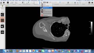 MPR con Osirix [upl. by Giffer]