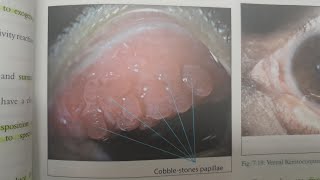 Vernal Keratoconjunctivitis  EYE [upl. by Schulein]