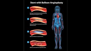 Peripheral Artery Disease PAD  Peripheral Vascular Disease PVD [upl. by Quentin469]