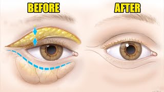 How To Get Rid Of Under Eye Bags [upl. by Isaacs692]