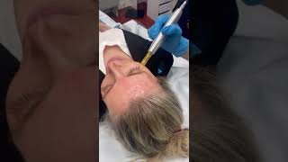 Exosome Skin Rejuvenation Regenerative Therapy With DermaPen 3 Microneedling [upl. by Einafpets]